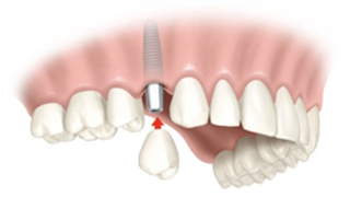 Imagen Implantes