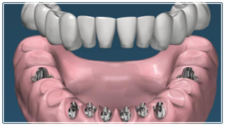 Imagen Implantes